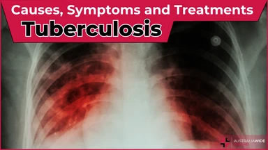 Tuberculosis article header – First Aid Article in Kiama